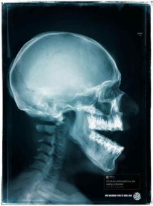 Burger King Created Adverts From X-Rays of Customers